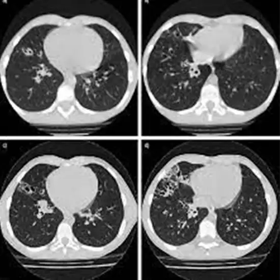 HRCT (High-Resolution Computed Tomography) Chest Test